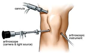 Sports injury Treatment Sports injury Treatment - Sports injury Clinic in bangalore